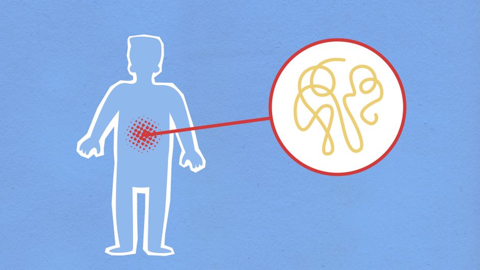 acid reflux esophagus diagram