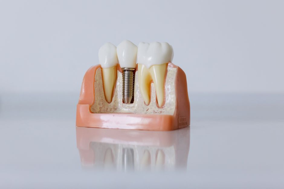 dental implant model close up