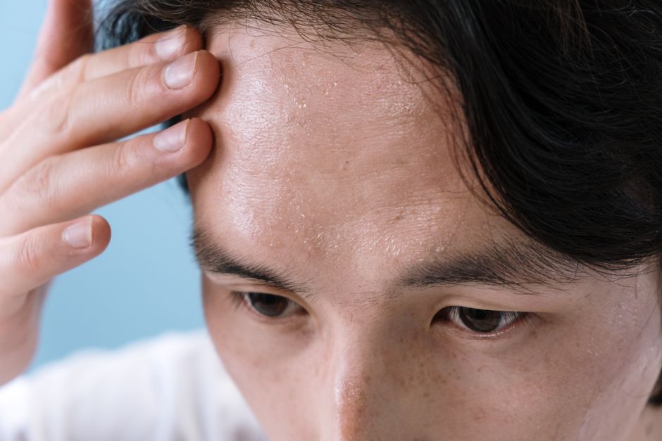 sweating forehead heat
