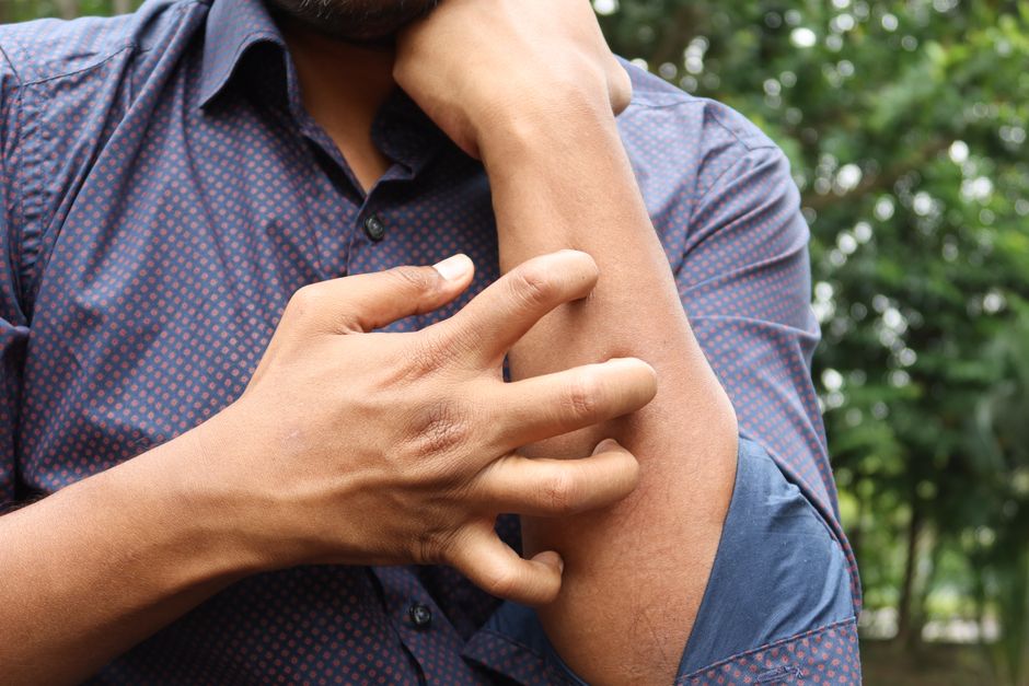 red skin irritation heat rash